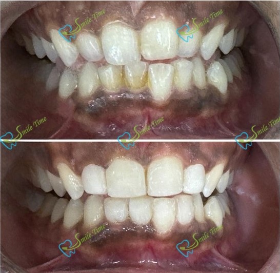 Dental Veneers